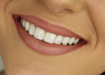 Why do you need cosmetic teeth braces?