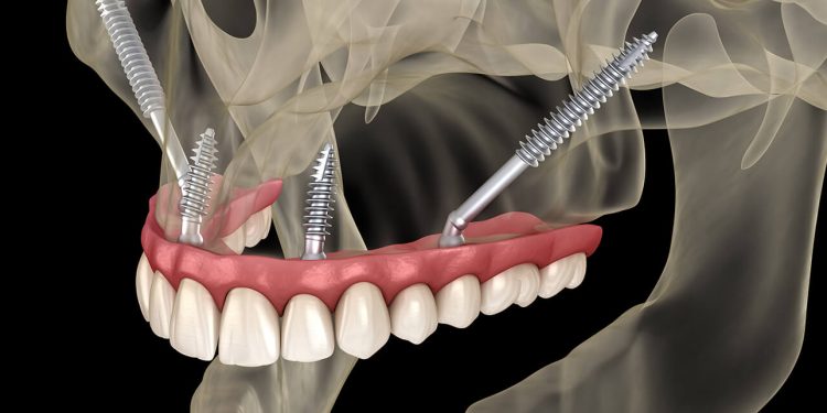 The Impact of Zygomatic Implants on Patients with Bone Loss
